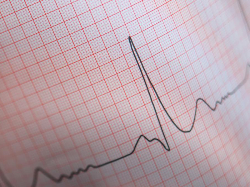 Aritmie:  Ruolo dell’ecg